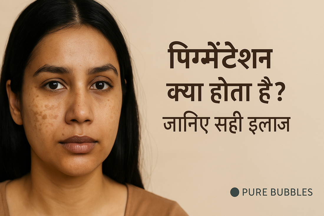 Close-up of a South Asian woman with visible pigmentation on her cheeks, looking calm. Beige background with Hindi text that reads "पिग्मेंटेशन क्या होता है? जानिए सही इलाज" and the Pure Bubbles logo.