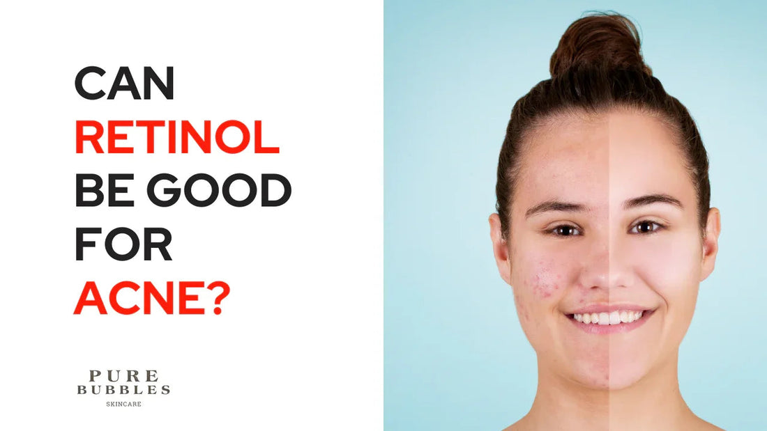 Retinol for acne: before and after skin transformation with clear, glowing results